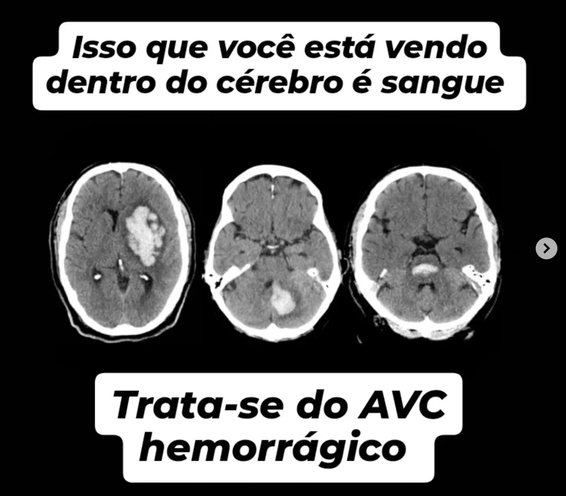 Publicação educativa sobre AVC hemorrágico